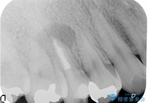右上5番の歯髄壊死に伴う大きな根尖病変に対する治療その①:矯正治療前の根管治療(イニシャルトリートメント)の治療後