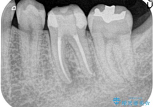 歯の神経が壊死・感染し、歯茎まで腫れていた左下6番への精密根管治療(イニシャルトリートメント)の治療後