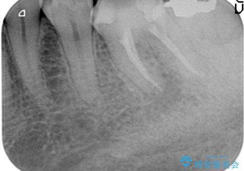 歯の神経が壊死・感染し、歯茎まで腫れていた左下6番への精密根管治療(イニシャルトリートメント)の治療後