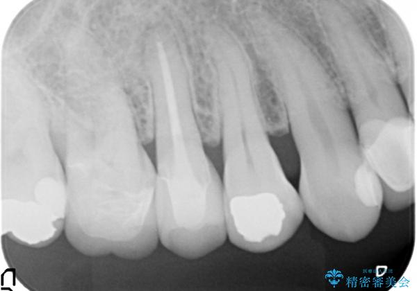 再根管治療（リトリートメント）症例：右上５番の根尖性歯周炎