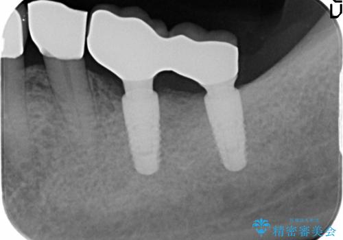 インプラントによる奥歯の咬合機能回復　クラウン高径のない場合骨外科による対応の治療後