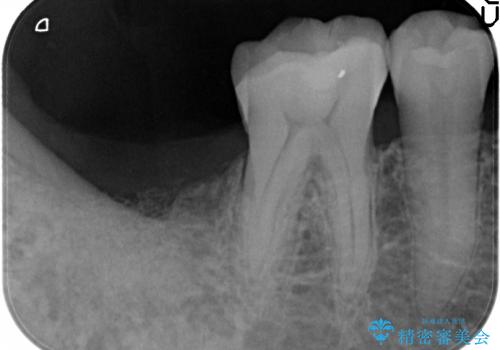 失った奥歯　インプラントによる咬合機能回復の治療前
