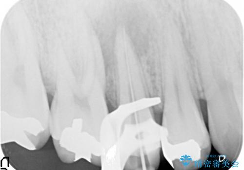 右上5番の歯髄壊死に伴う大きな根尖病変に対する治療その①:矯正治療前の根管治療(イニシャルトリートメント)の治療中