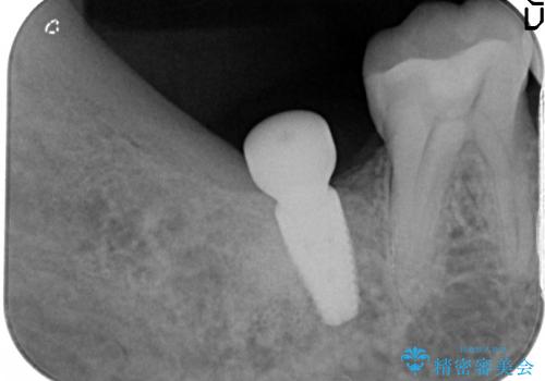 失った奥歯　インプラントによる咬合機能回復の治療中