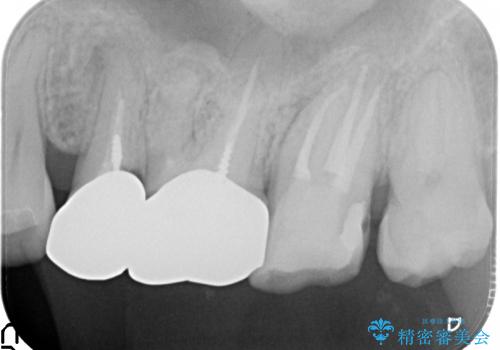 膿の出口(瘻孔)と患歯の位置にずれがあったケース:左上7番の再根管治療の治療後