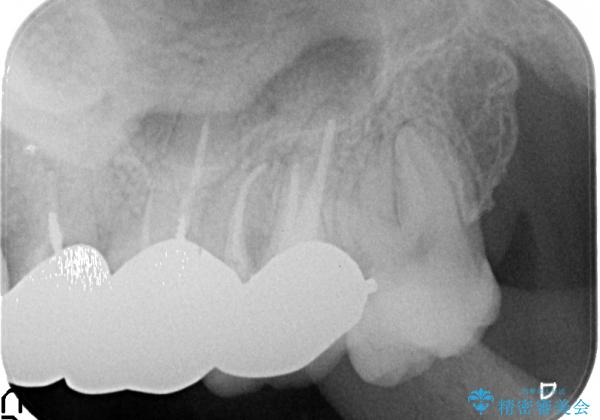 膿の出口(瘻孔)と患歯の位置にずれがあったケース:左上7番の再根管治療