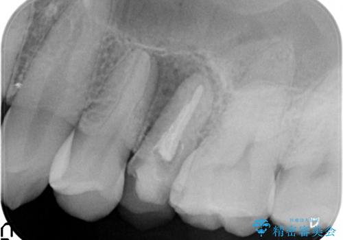 楕円形の根管に大きな根尖病変 (根尖性歯周炎)を持つ左上5番の根尖性歯周炎 : 再根管治療(リトリートメント)症例の治療前