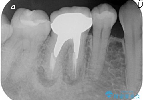金属が露出してしまった歯の審美的補綴処置の治療前