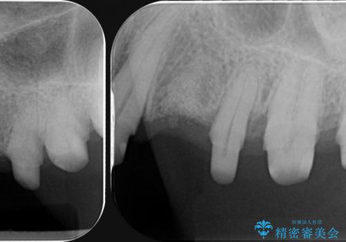 歯ぎしりで歯がグラグラ　噛み合わせを改善するブリッジ治療の治療中