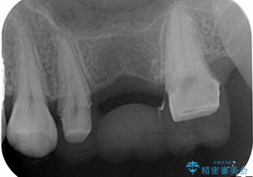 保存不可能な歯のフラップ診断からブリッジ治療の治療中