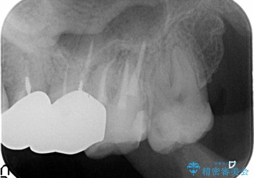 膿の出口(瘻孔)と患歯の位置にずれがあったケース:左上7番の再根管治療の治療後