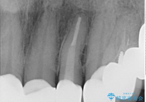 長い金属ポストの除去を伴う前歯の再根管治療症例の治療後