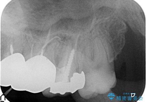 膿の出口(瘻孔)と患歯の位置にずれがあったケース:左上7番の再根管治療の治療前