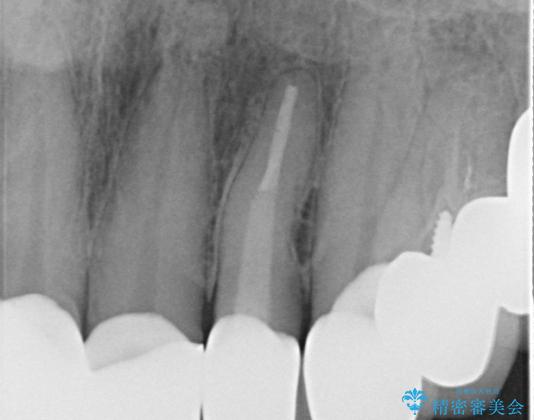 長い金属ポストの除去を伴う前歯の再根管治療症例