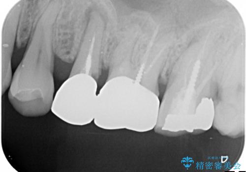 膿の出口(瘻孔)と患歯の位置にずれがあったケース:左上7番の再根管治療の治療前