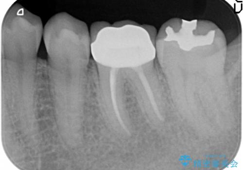 歯の神経が壊死・感染し、歯茎まで腫れていた左下6番への精密根管治療(イニシャルトリートメント)
