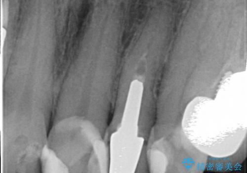 長い金属ポストの除去を伴う前歯の再根管治療症例の治療前