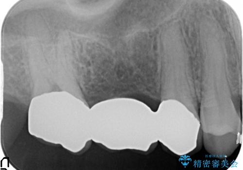 歯周外科手術を併用し清掃性を高めたブリッジ治療の治療後