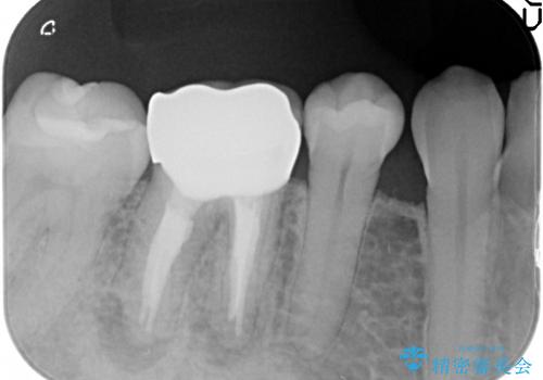 金属が露出してしまった歯の審美的補綴処置の治療後