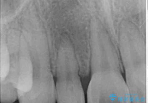 矮小歯　前歯の小さな歯を自然な形にの治療前