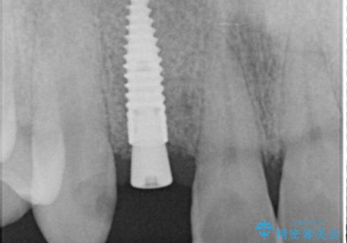 [ 骨造成を伴う前歯審美インプラント① ] インプラント埋入→2次手術の治療後