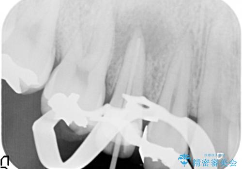 右上5番の歯髄壊死に伴う大きな根尖病変に対する治療その①:矯正治療前の根管治療(イニシャルトリートメント)の治療中
