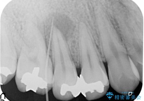 右上5番の歯髄壊死に伴う大きな根尖病変に対する治療その①:矯正治療前の根管治療(イニシャルトリートメント)の治療前