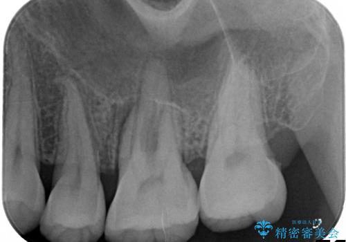保存不可能な歯のフラップ診断からブリッジ治療の治療前