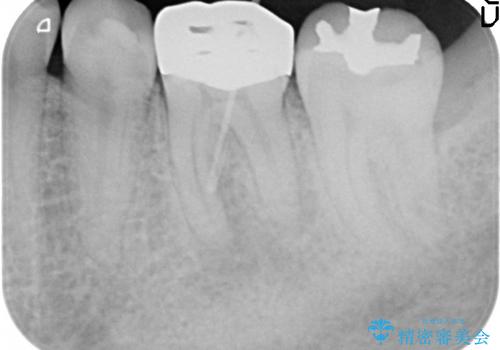 歯の神経が壊死・感染し、歯茎まで腫れていた左下6番への精密根管治療(イニシャルトリートメント)の治療前