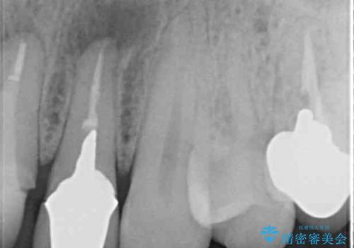 歯の根元が露出してきた　オールセラミックの再補綴での改善の治療前