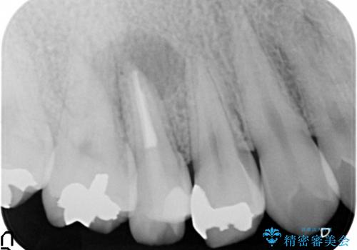 右上5番の歯髄壊死に伴う大きな根尖病変に対する治療その①:矯正治療前の根管治療(イニシャルトリートメント)