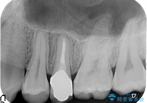 楕円形の根管に大きな根尖病変 (根尖性歯周炎)を持つ左上5番の根尖性歯周炎 : 再根管治療(リトリートメント)症例の治療後