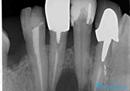 [ 前歯の歯周病治療① ]  再生治療・歯周ポケット除去の治療前
