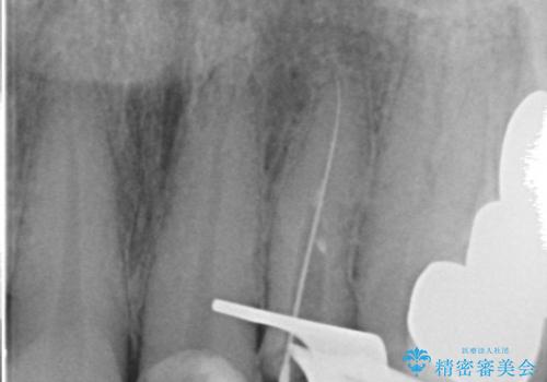 長い金属ポストの除去を伴う前歯の再根管治療症例の治療中