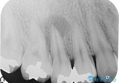右上5番の歯髄壊死に伴う大きな根尖病変に対する治療その①:矯正治療前の根管治療(イニシャルトリートメント)の治療前
