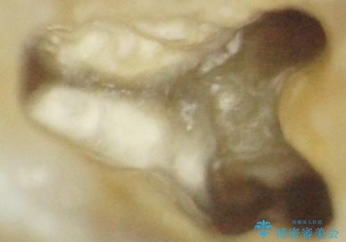 膿の出口(瘻孔)と患歯の位置にずれがあったケース:左上7番の再根管治療の治療中