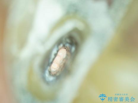 楕円形の根管に大きな根尖病変 (根尖性歯周炎)を持つ左上5番の根尖性歯周炎 : 再根管治療(リトリートメント)症例の治療中
