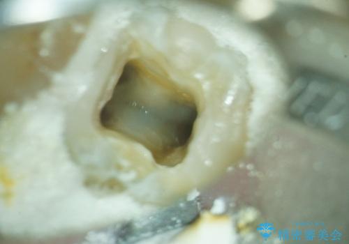 歯の神経が壊死・感染し、歯茎まで腫れていた左下6番への精密根管治療(イニシャルトリートメント)の治療中