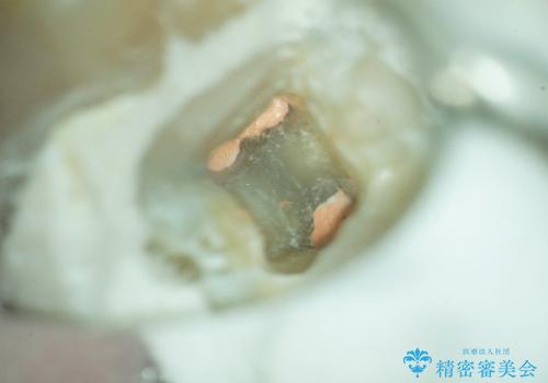 歯の神経が壊死・感染し、歯茎まで腫れていた左下6番への精密根管治療(イニシャルトリートメント)の治療中