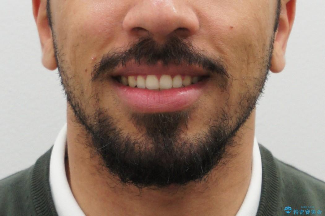 歯周病治療後の矯正　エジプトからの転院の治療後（顔貌）