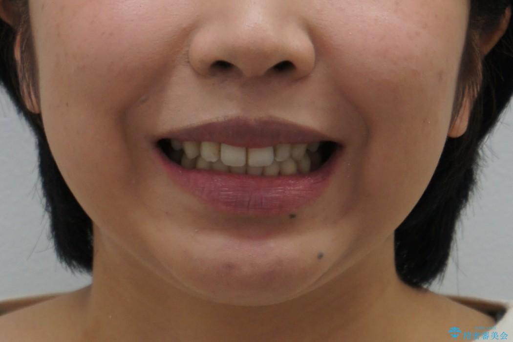 30代女性　重度の出っ歯を美しくの治療後（顔貌）