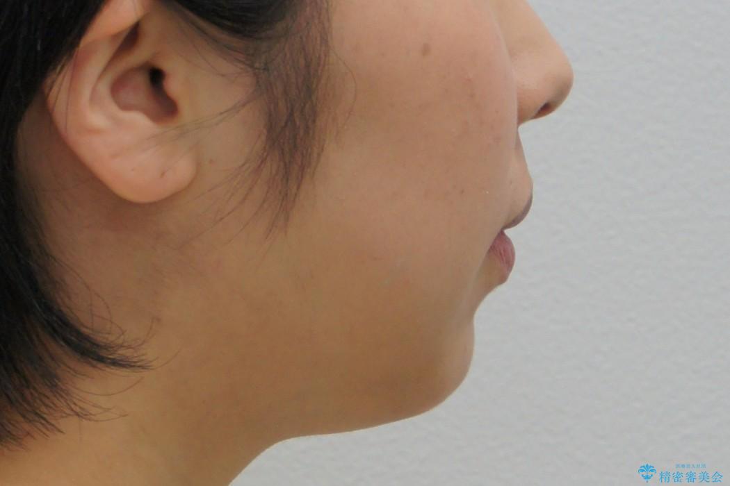 30代女性　重度の出っ歯を美しくの治療後（顔貌）