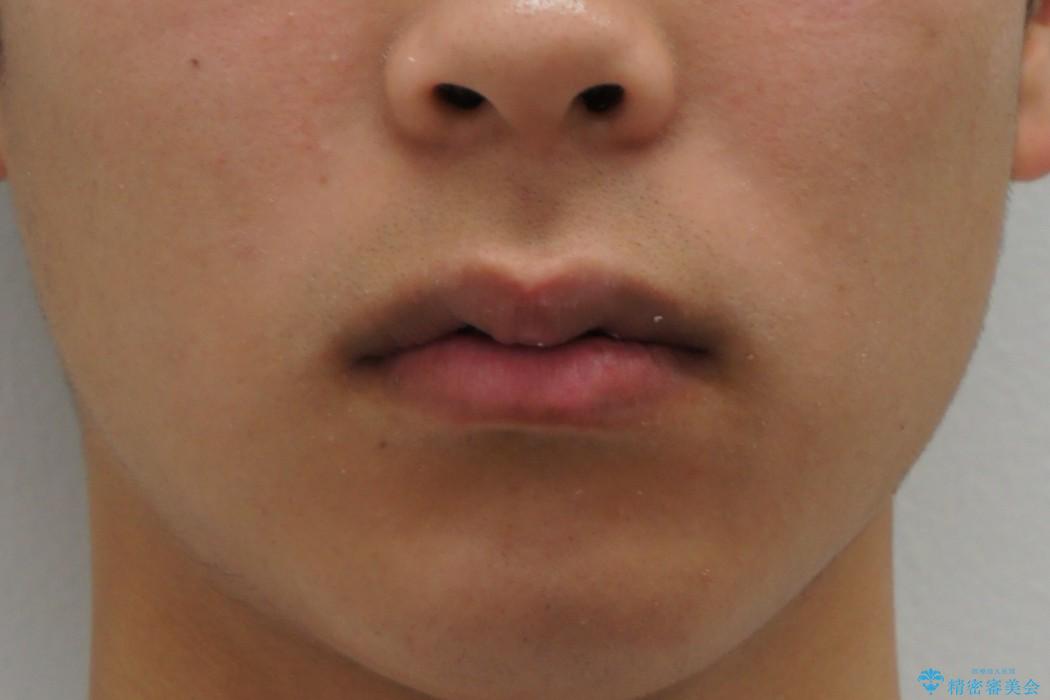 10代男性　出っ歯　歯を抜かない矯正の治療後（顔貌）