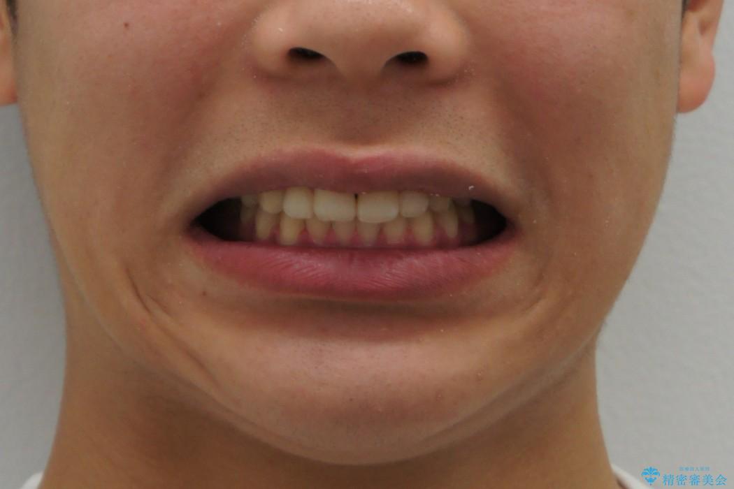 10代男性　出っ歯　歯を抜かない矯正の治療後（顔貌）