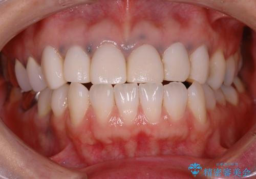 反対咬合　矯正歯科治療と審美歯科治療によりきれいな口元への治療前
