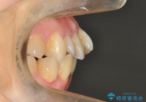 20代女性　ガタガタの歯を矯正してきれいに　表のワイヤー矯正の治療前