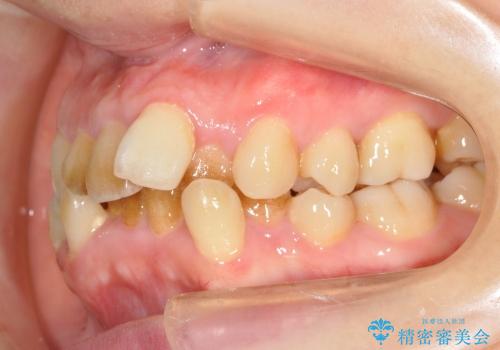 20代女性　ガタガタの歯を矯正してきれいに　表のワイヤー矯正の治療前
