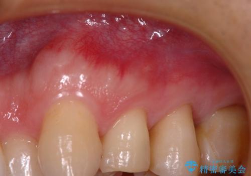 矯正治療前の根管治療 : 歯髄の壊死により、根の先に膿が生じ、歯ぐきに膿の出口ができていたケースへのイニシャルトリートメントの治療中