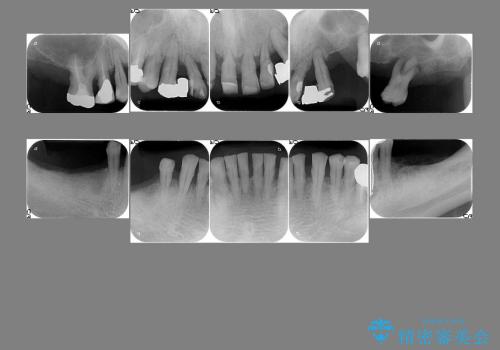 上顎の歯が一本も残せない人のインプラント治療の治療前