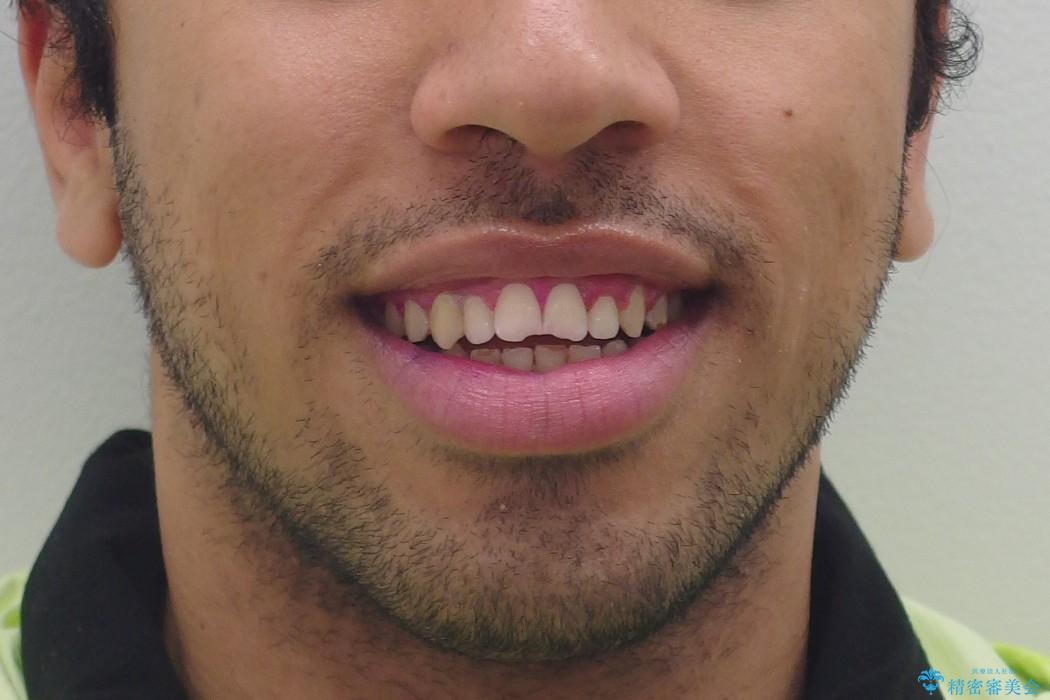 歯周病治療後の矯正　エジプトからの転院の治療前（顔貌）